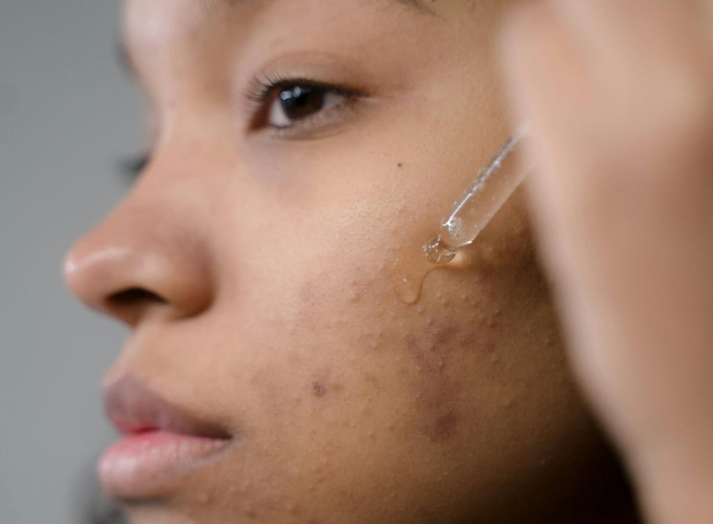 Doctor Reveals 7 Skin Conditions Even Experts Miss in Skin of&nbsp;Colour